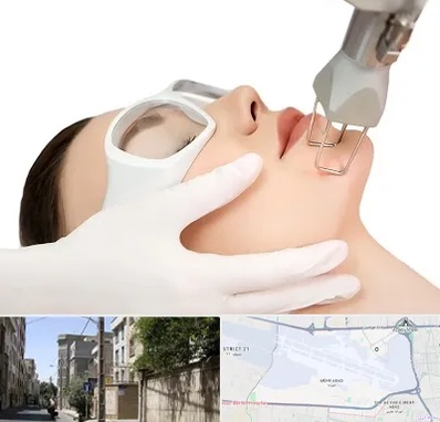 لیزر فرکشنال در مهرآباد
