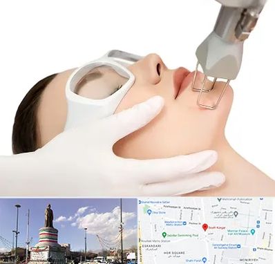 لیزر فرکشنال در کارگر جنوبی 