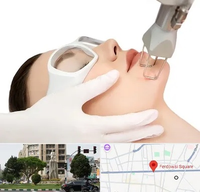 لیزر فرکشنال در میدان فردوسی تهران