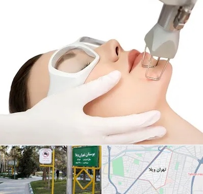 لیزر فرکشنال در تهران ویلا