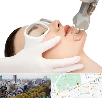 لیزر فرکشنال در بلوار کشاورز 