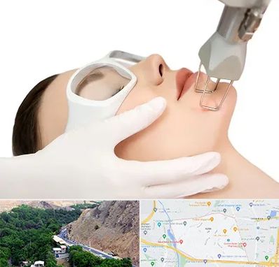 لیزر فرکشنال در کن 