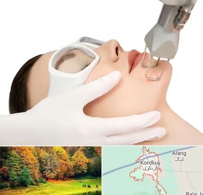 لیزر فرکشنال در کردکوی