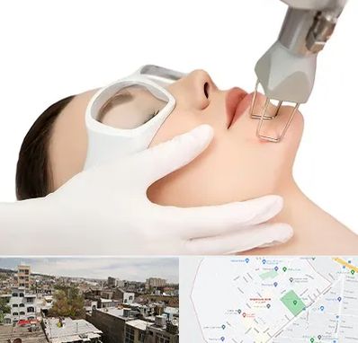 لیزر فرکشنال در شمیران نو