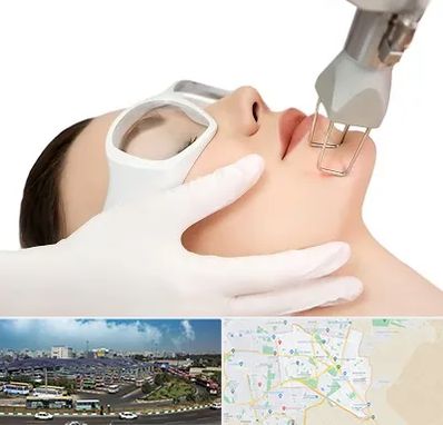 لیزر فرکشنال در منطقه 15 تهران 