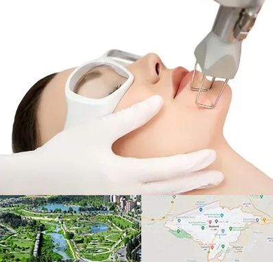 لیزر فرکشنال در بجنورد