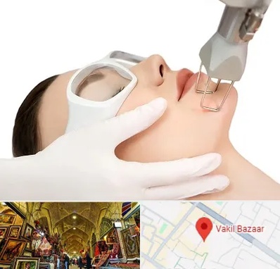 لیزر فرکشنال در بازار وکیل شیراز