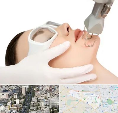 لیزر فرکشنال در منطقه 18 تهران 