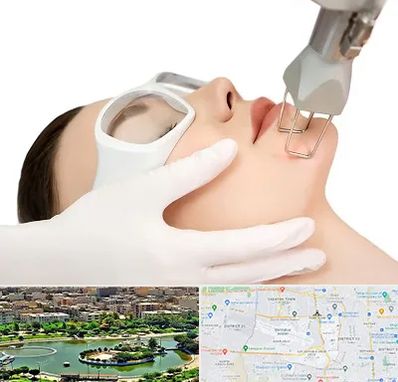 لیزر فرکشنال در منطقه 9 تهران 