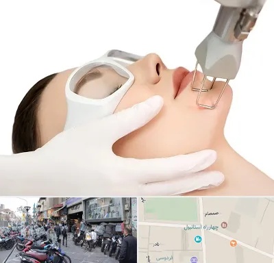 لیزر فرکشنال در چهارراه استانبول