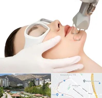 لیزر فرکشنال در شهر زیبا 