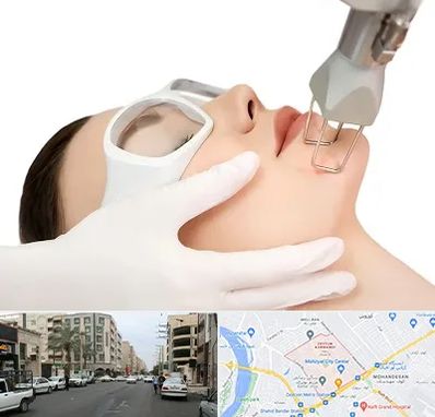 لیزر فرکشنال در زیتون کارمندی اهواز