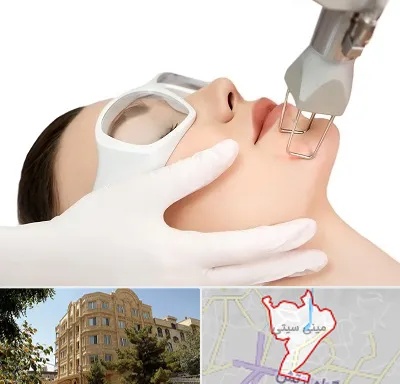 لیزر فرکشنال در مینی سیتی