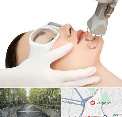 لیزر فرکشنال در زرگنده
