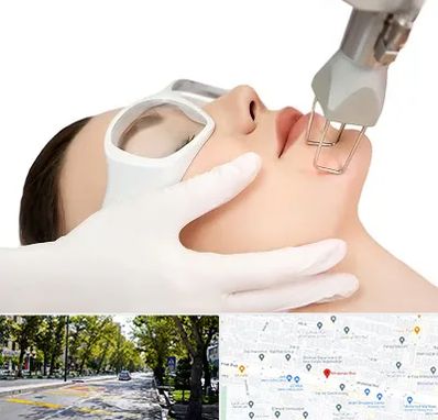 لیزر فرکشنال در میرداماد 