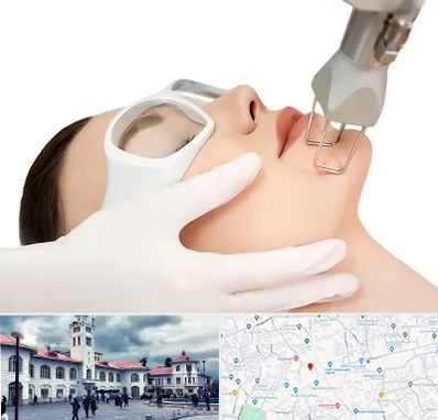 لیزر فرکشنال در میدان شهرداری رشت