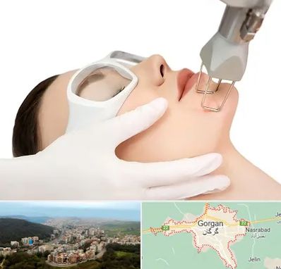 لیزر فرکشنال در گرگان