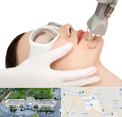 لیزر فرکشنال در نسیم شهر