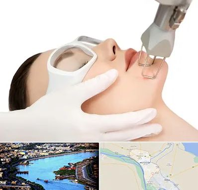 لیزر فرکشنال در خرمشهر