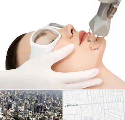 لیزر فرکشنال در جیحون