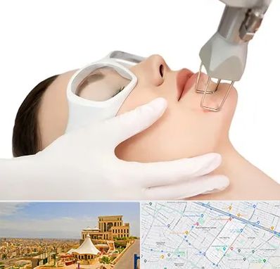 لیزر فرکشنال در هاشمیه مشهد