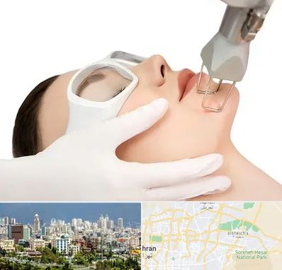 لیزر فرکشنال در شرق تهران 