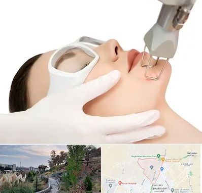 لیزر فرکشنال در باغستان کرج