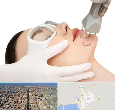 لیزر فرکشنال در بندر ماهشهر