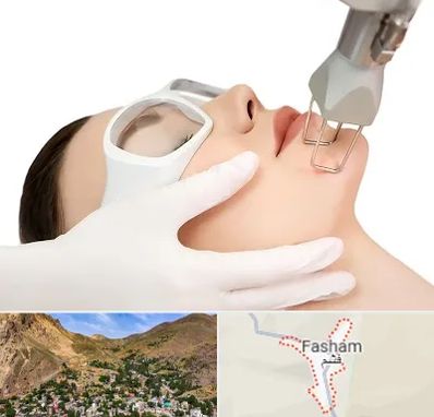 لیزر فرکشنال در فشم