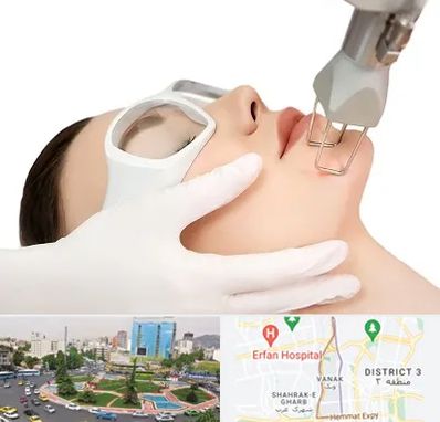 لیزر فرکشنال در ونک 