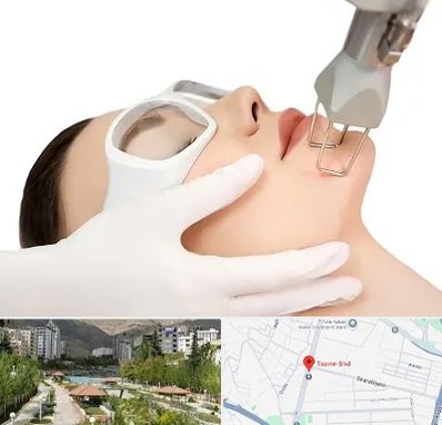 لیزر فرکشنال در بلوار تعاون