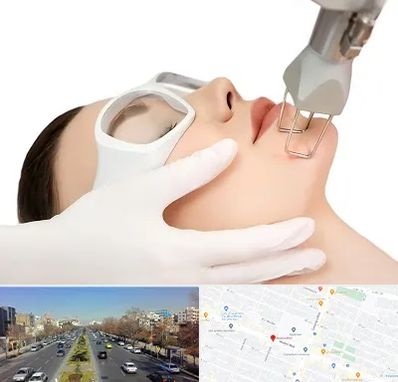 لیزر فرکشنال در بلوار معلم مشهد 