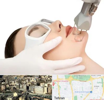 لیزر فرکشنال در مرزداران 