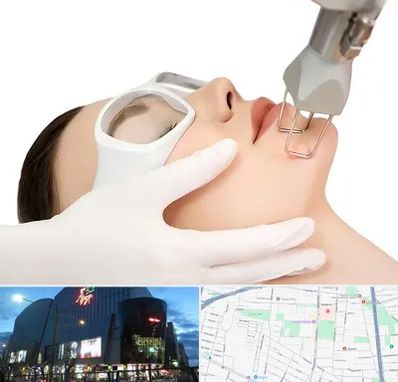 لیزر فرکشنال در بلوار اباذر