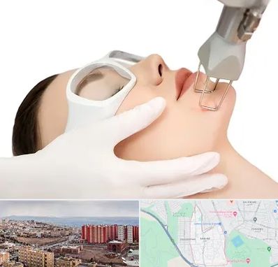 لیزر فرکشنال در سهند تبریز