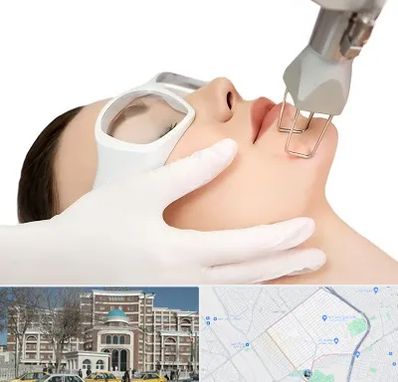 لیزر فرکشنال در طلاب مشهد