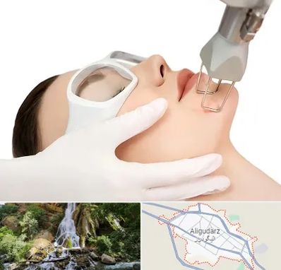 لیزر فرکشنال در الیگودرز