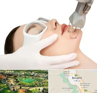 لیزر فرکشنال در بروجرد