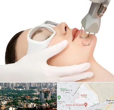 لیزر فرکشنال در عظیمیه کرج 