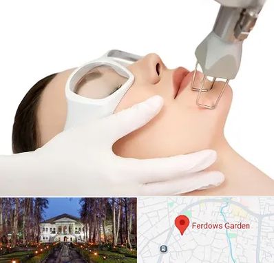 لیزر فرکشنال در باغ فردوس