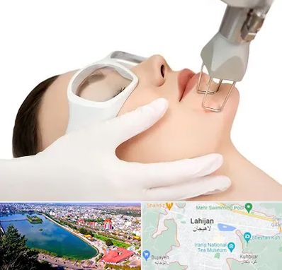 لیزر فرکشنال در لاهیجان