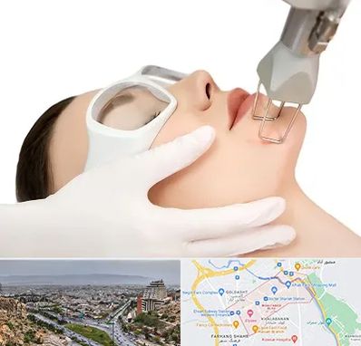 لیزر فرکشنال در معالی آباد شیراز