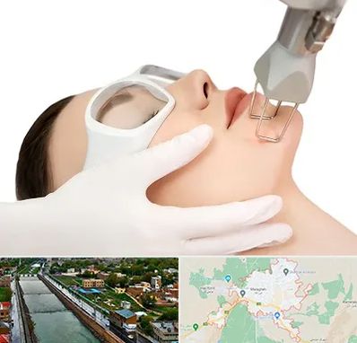 لیزر فرکشنال در مراغه