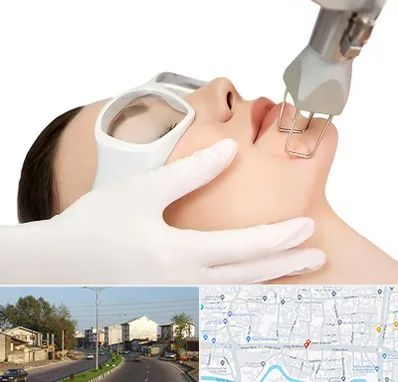 لیزر فرکشنال در ضیابری رشت