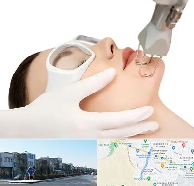 لیزر فرکشنال در شریعتی مشهد