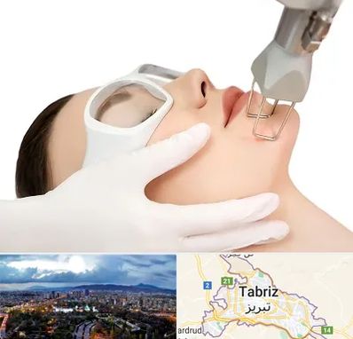 لیزر فرکشنال در تبریز
