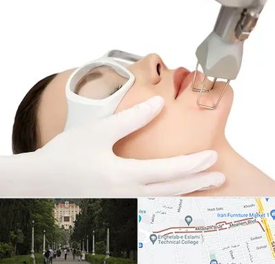 لیزر فرکشنال در بلوار معلم رشت 