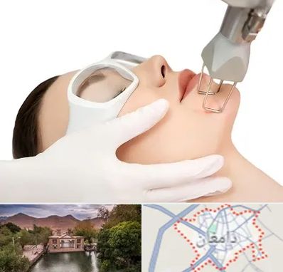لیزر فرکشنال در دامغان