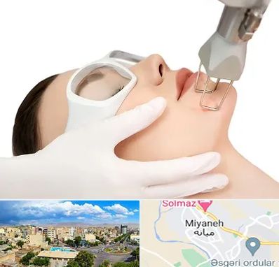 لیزر فرکشنال در میانه