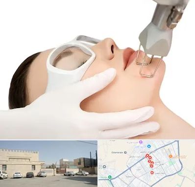 لیزر فرکشنال در نواب اسلامشهر